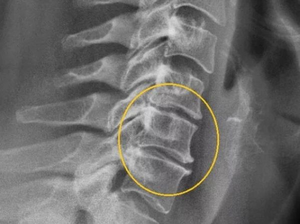Dzemdes kakla mugurkaula osteohondroze uz x -ray