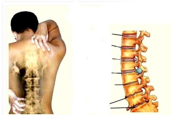osteohondroze ir muguras sāpju cēlonis